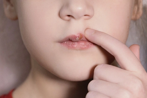 sintomas del herpes labial
