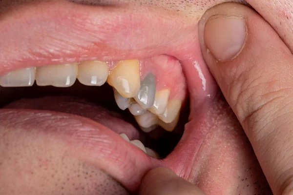 causas de los dientes negros