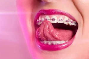 mejores colores de ligas de brackets