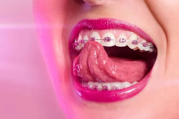 mejores colores de ligas de brackets