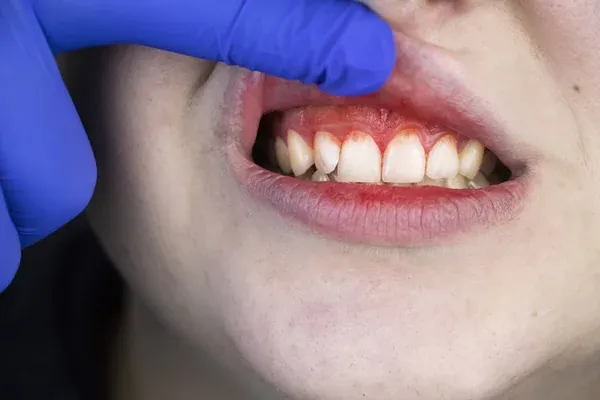 paciente con gingivitis