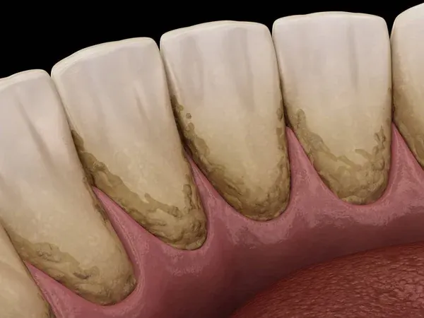 Por qué aparece el sarro dental en los dientes