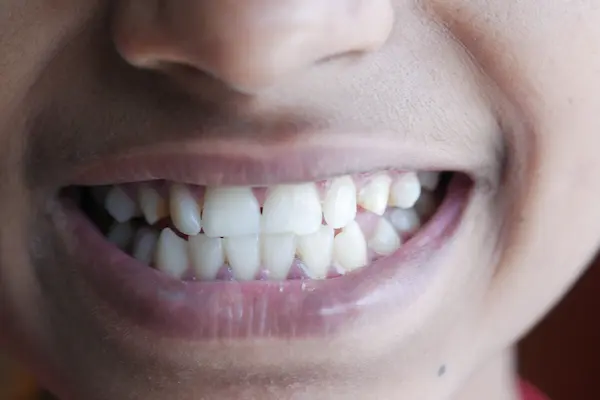 ¿Qué significa rechinar los dientes al dormir?